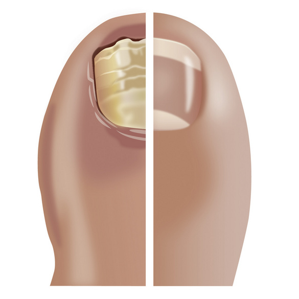 Medonail Soins des ongles en cas d'infection fongique