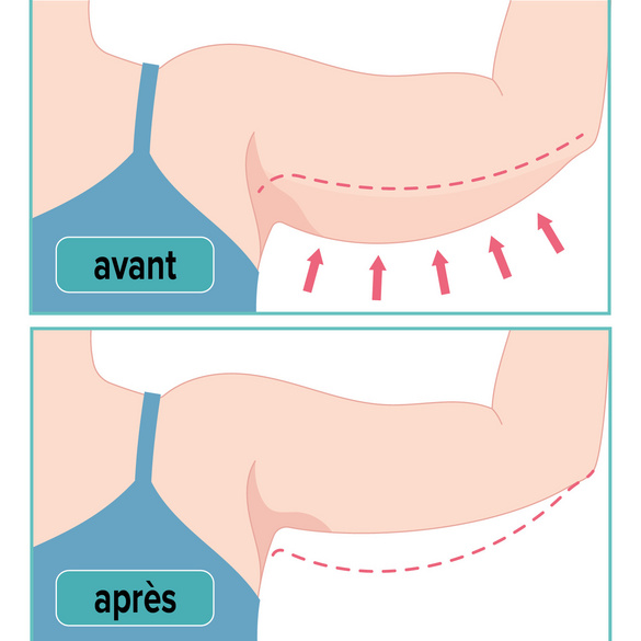 Lot de 2 manchons de compression pour le haut des bras