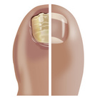 Medonail Soins des ongles en cas d'infection fongique